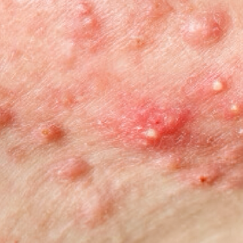 Pustules