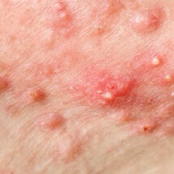 Pustules